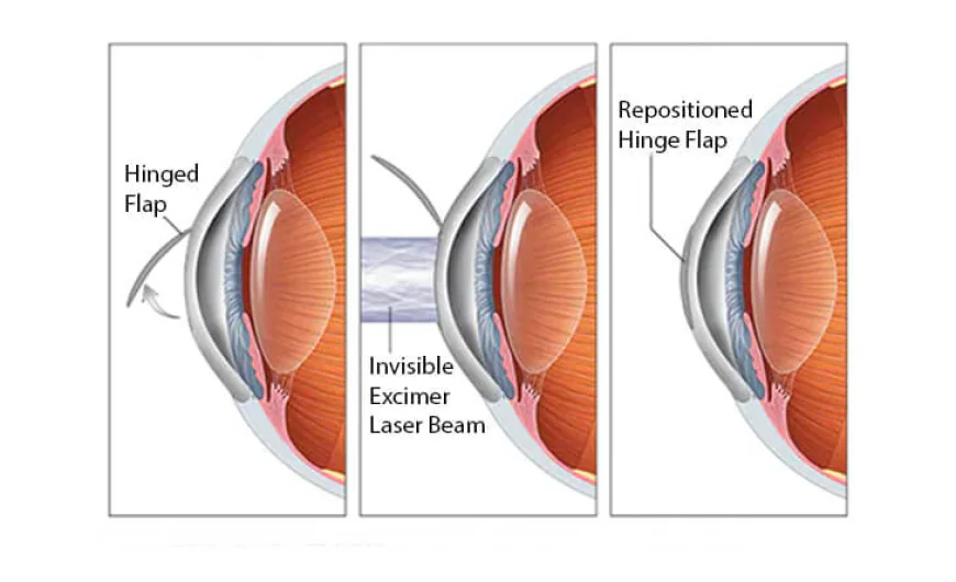 Lasik Surgery in Delhi - Dr Anisha Gupta