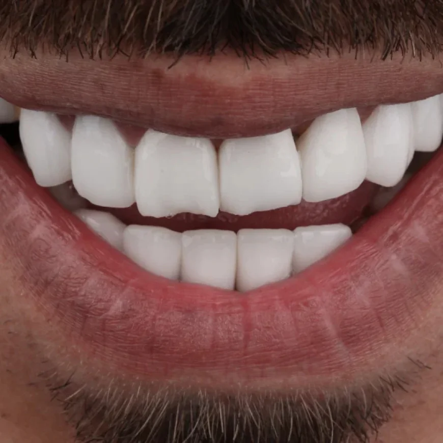 How Natural Is the Shade Selection for Composite Veneers?