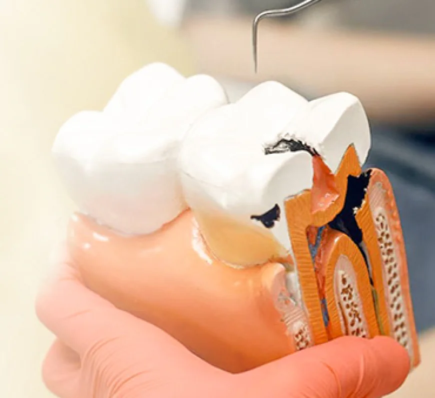 Seamless Root Canal and Dental Treatments in India for International Patients