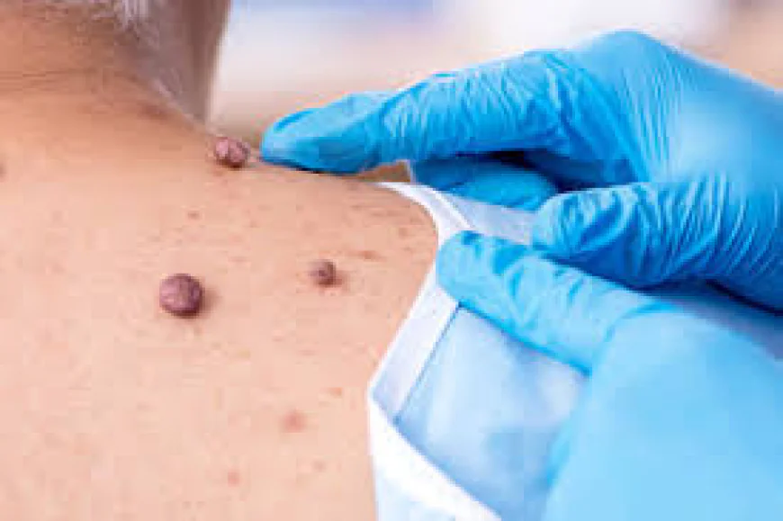 Smooth Skin: What You Should Know About Mole Removal in Dubai