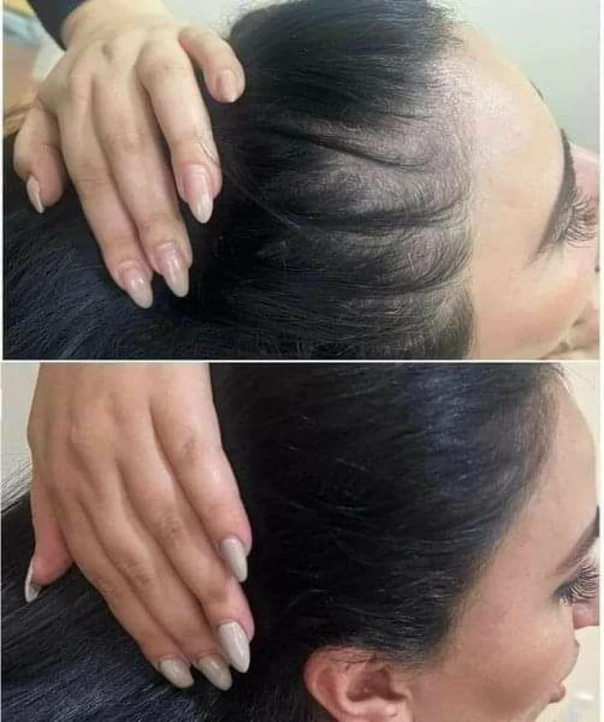 Hybrid Hair Transplant in Dubai: Advanced Solutions for Women