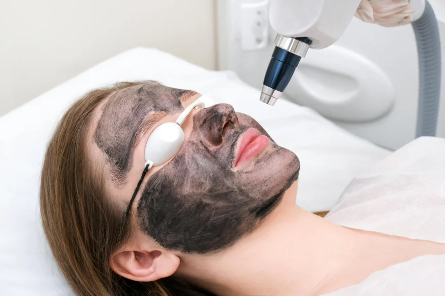 How Long Does a Laser Carbon Peel Session Take?