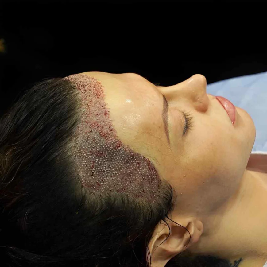 FUE Hair Transplant in Islamabad: A Complete Hair Loss Solution