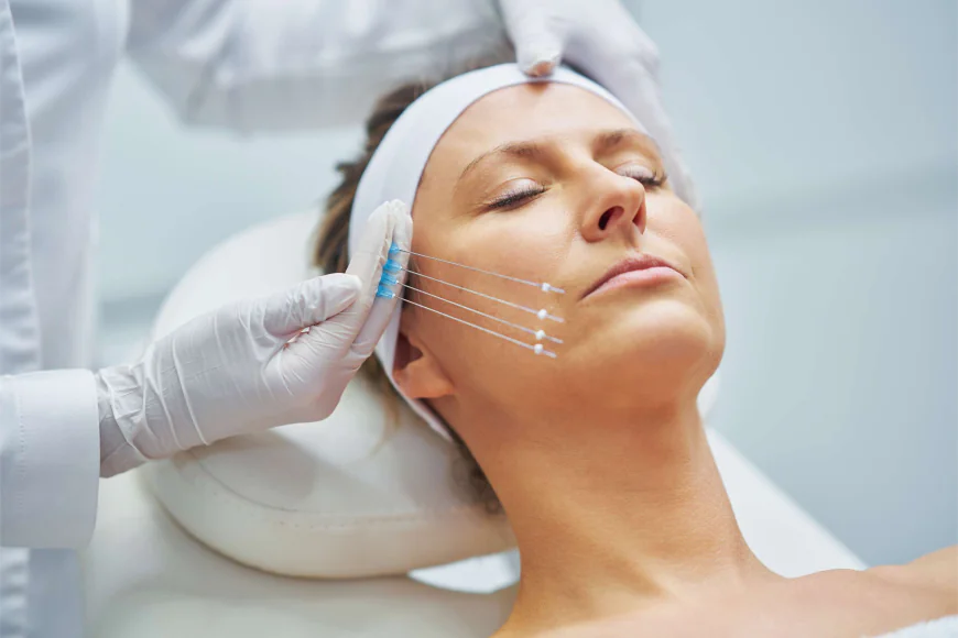How Thread Lifts Boost Collagen Production Naturally
