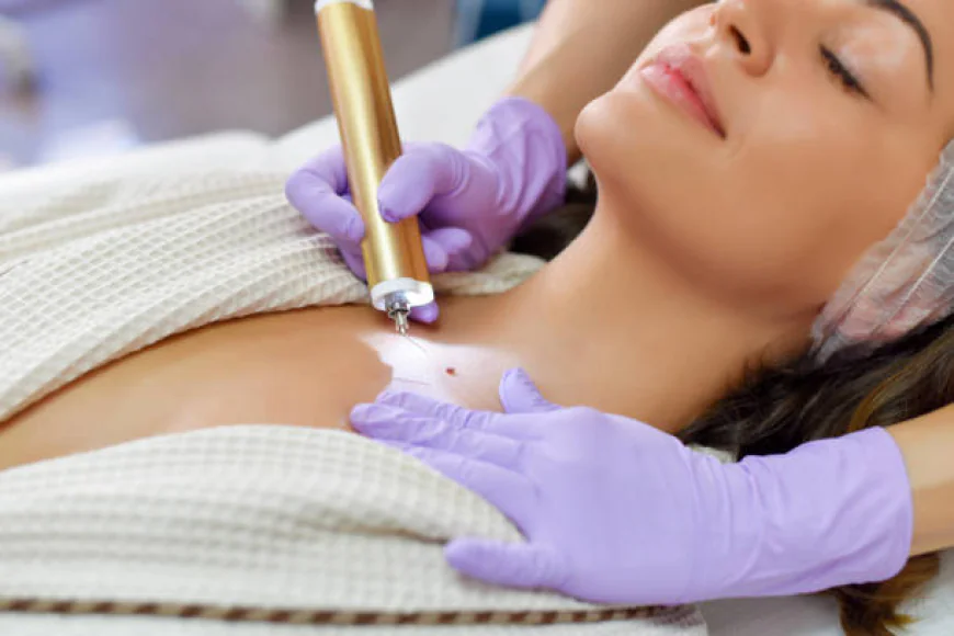 Mole Removal in Dubai: Minimal Recovery, Maximum Results