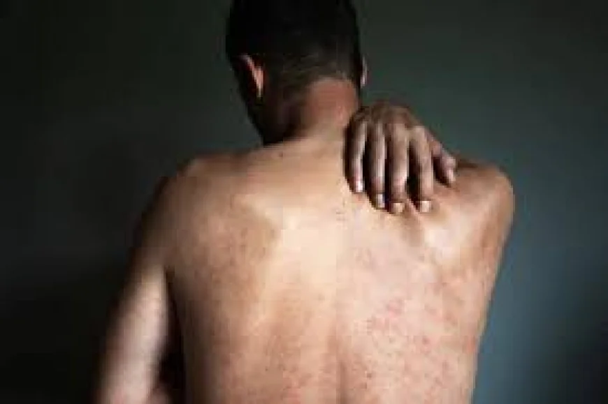 What Treatment Techniques Help You Get Rid of Back Acne More Easily?: