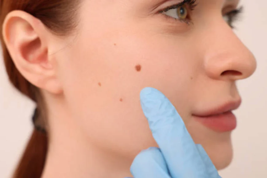 Signs That Indicate You May Need Mole Removal