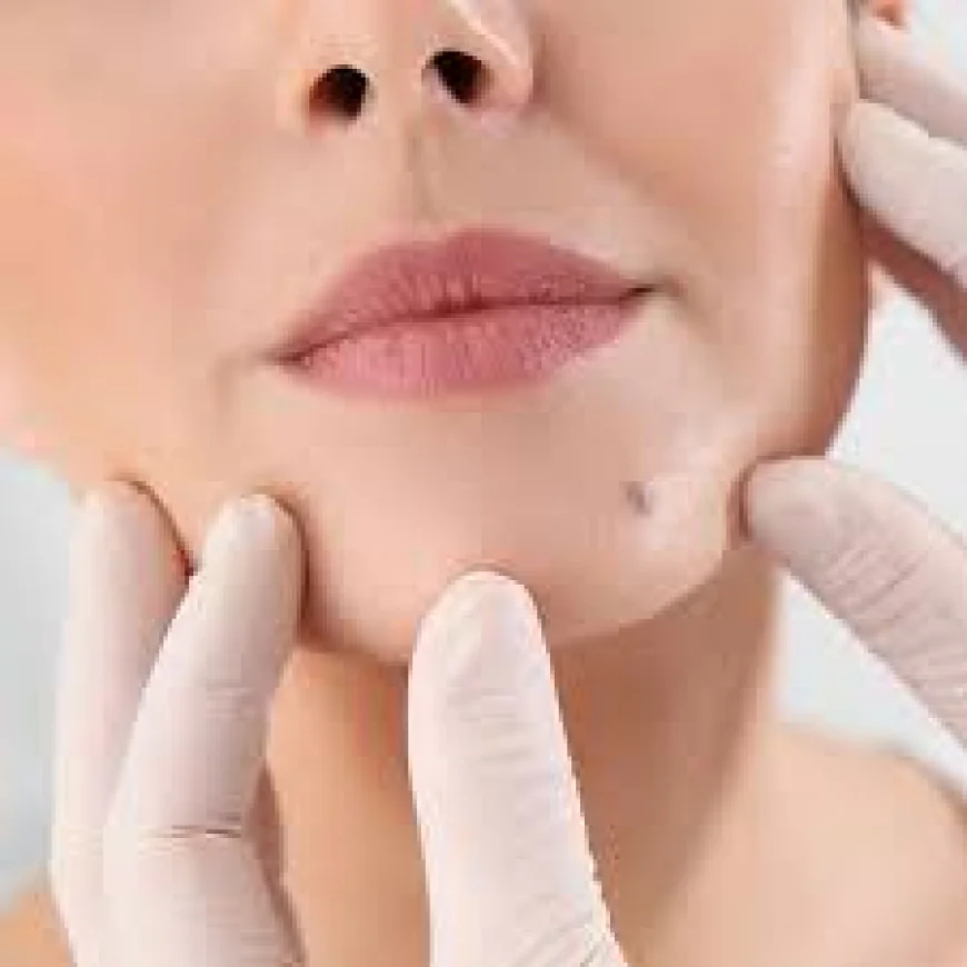 Best Mole Removal in Dubai: Safe & Effective