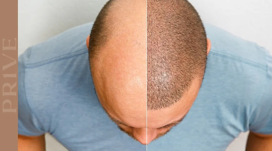 Hair Transplant in Sharjah for Men and Women: A Complete Guide