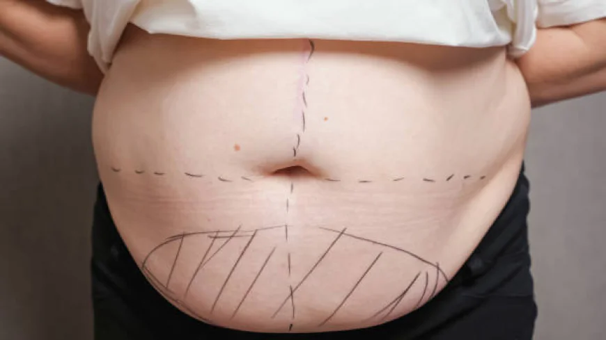Circumferential Abdominoplasty Dubai: Total Body Contouring