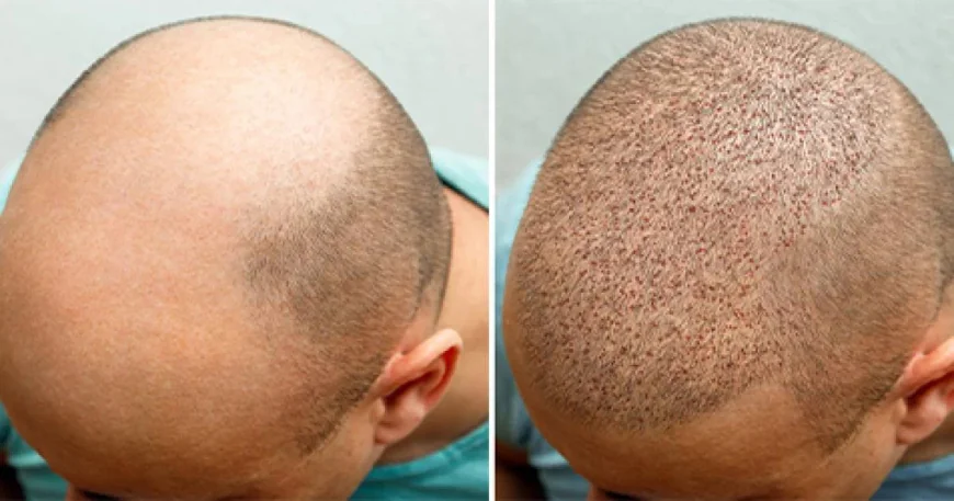 Scarless Hair Transplant in Dubai