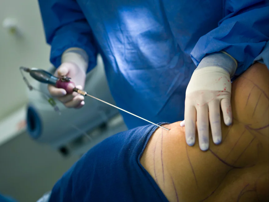 Liposuction: A Complete Beginner’s Guide to Body Contouring