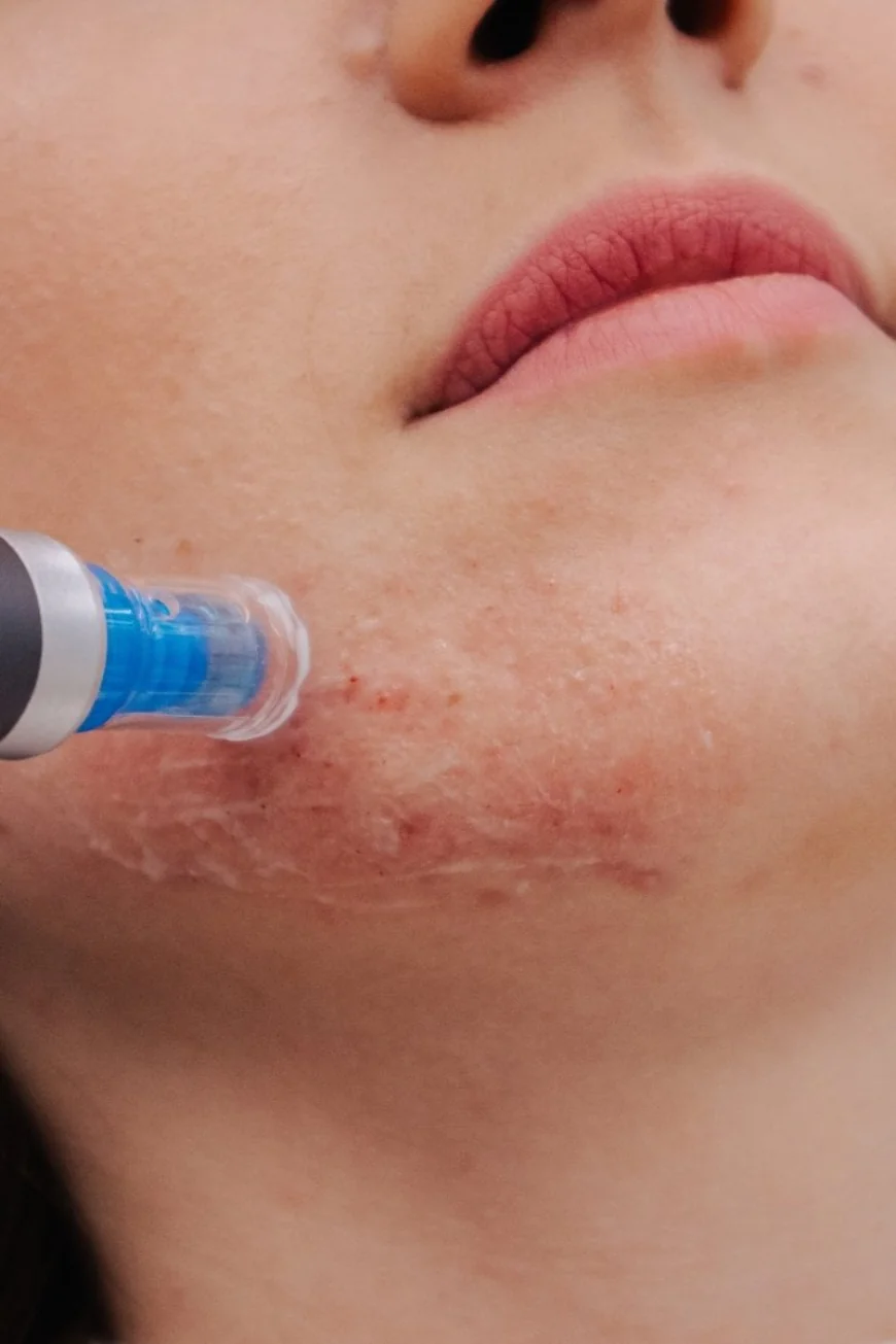 Dermapen Treatment Dubai for Safe Microneedling Care