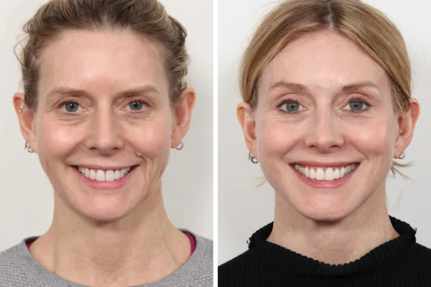 Best Plastic Surgeons in Dubai: Achieving Natural Beauty with Thread Lift
