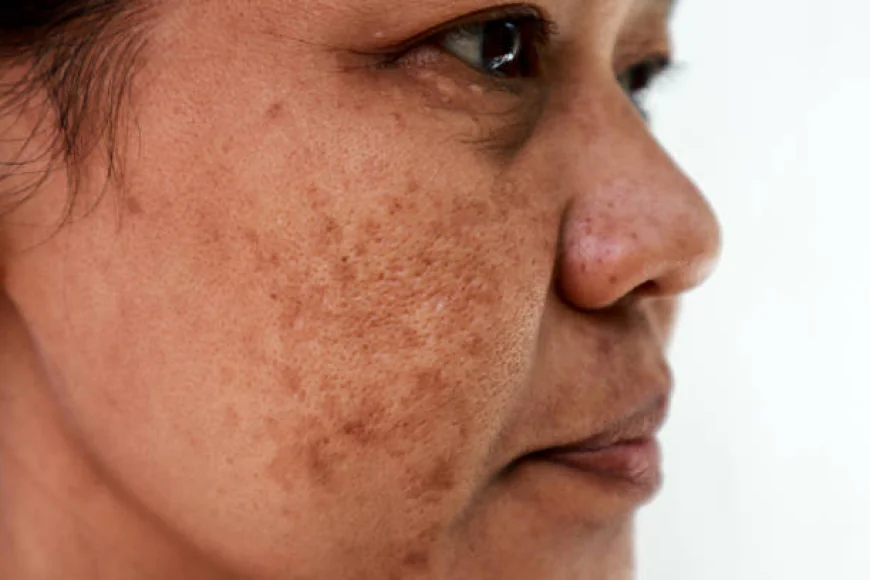 Melasma Treatment: How to Reduce Dark Spots Safely