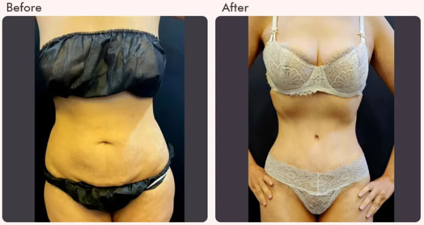 Tummy Tuck Surgery in Delhi - Dr Rajat Gupta
