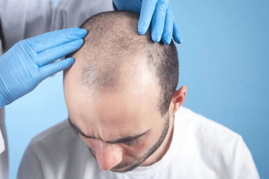 Hair Transplant in Islamabad: Why Choose a Certified Surgeon