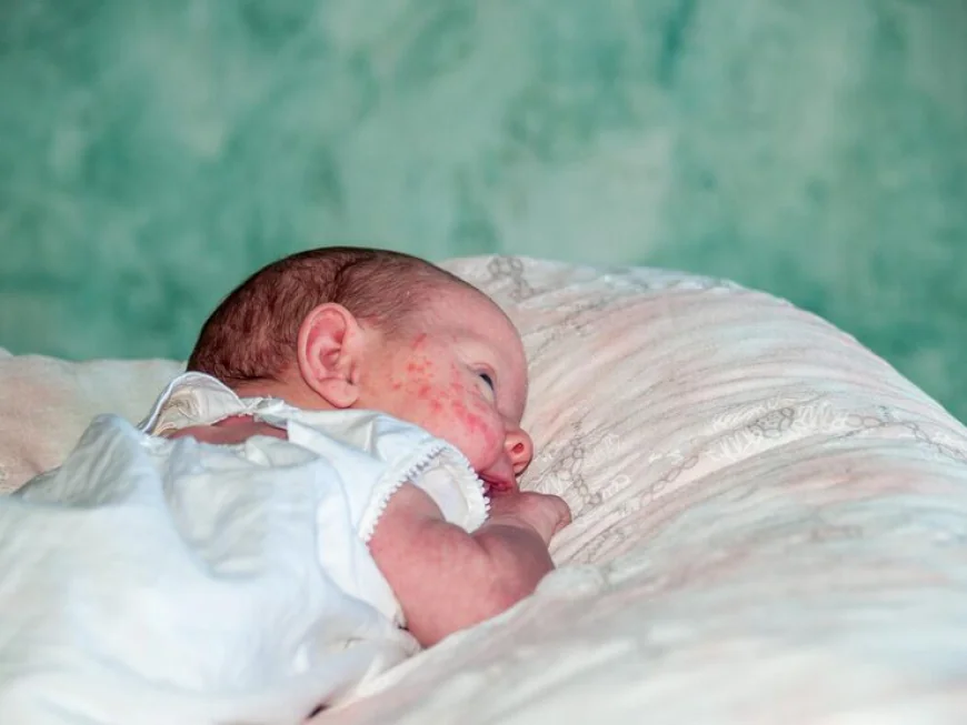 Recognizing Neonatal Lupus in Newborns: Key Signs and Treatment Options