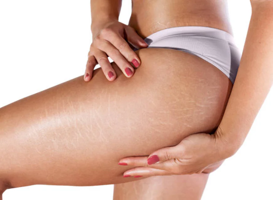 Stretch Mark Removal Treatments to Try Today