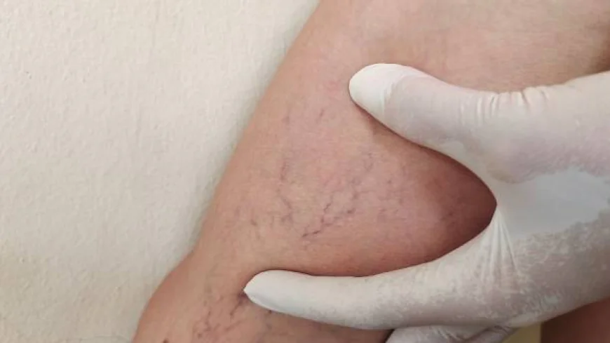 Beginner’s Guide to Cost of Varicose Vein Treatment