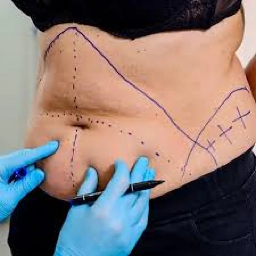 Liposuction in Islamabad – A Complete Guide to Body Contouring and Fat Removal