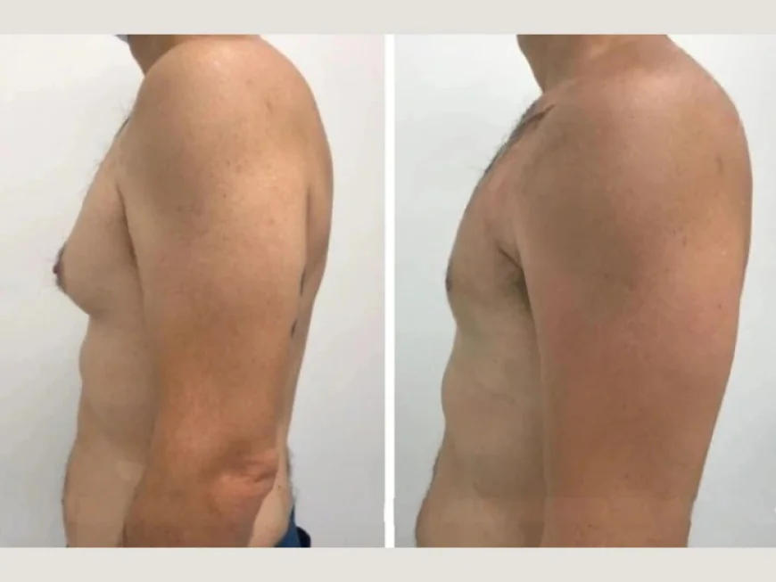 Restore Your Shape with the Best Gynecomastia Doctors in Dubai