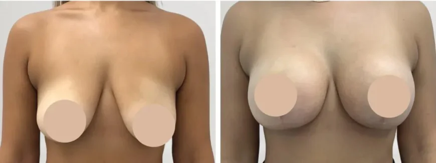 Breast Reduction in Dubai for Refined Feminine Contours