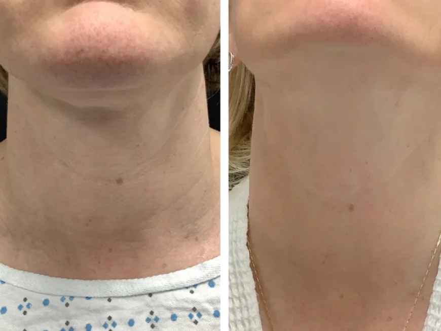Best Doctors in dubai for Collagen-Boosting Radiofrequency Microneedling