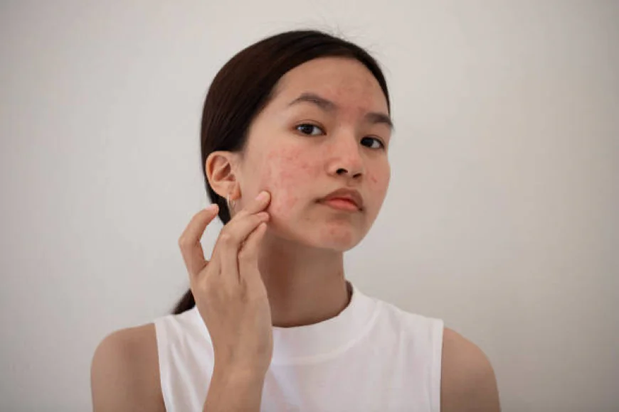 Reduce Inflammation Fast with Laser Acne Fix