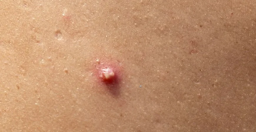 Skin Tag Removal in Dubai: Trusted Skin Specialists Guide