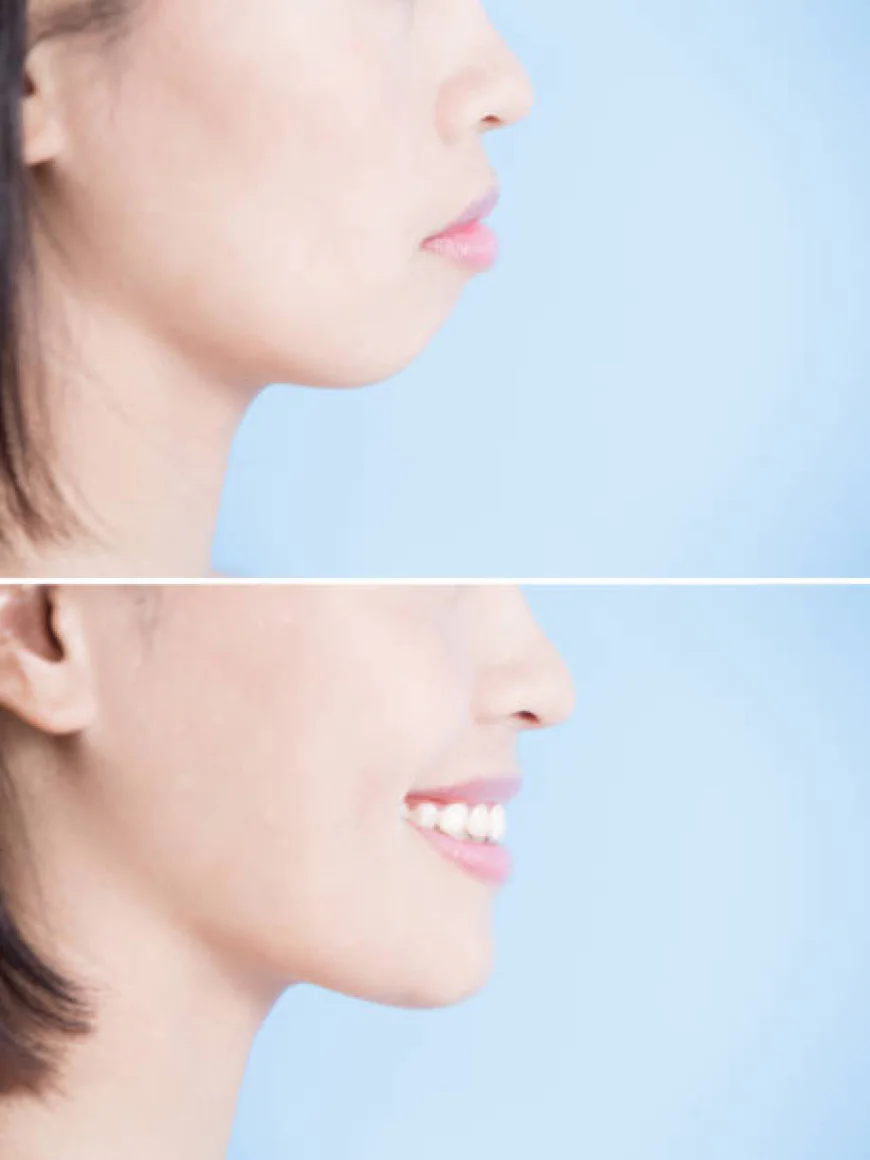 Chin Augmentation in Dubai Before and After Transformations