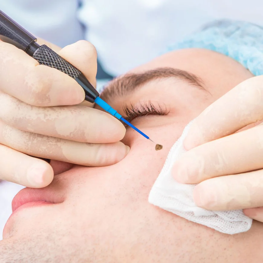 Mole Removal in Dubai: Professional Care for Flawless Skin