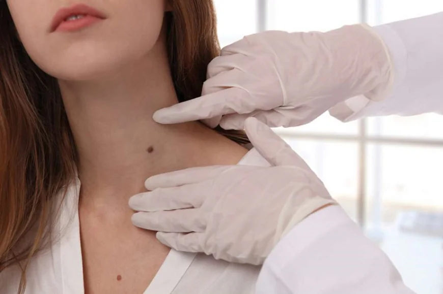 Mole Removal In Dubai Pain-Free Solutions for All Ages