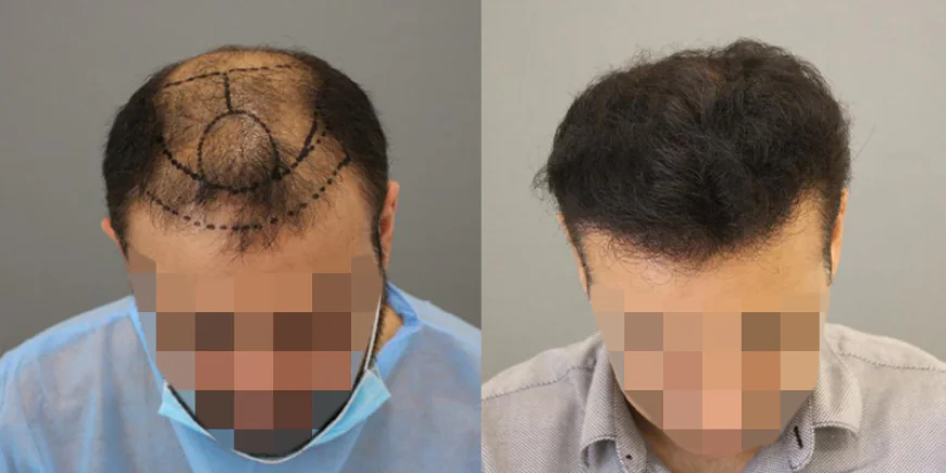 انقلاب في مظهرك: اكتشف سر زراعة الشعر الناجحة في الرياض
