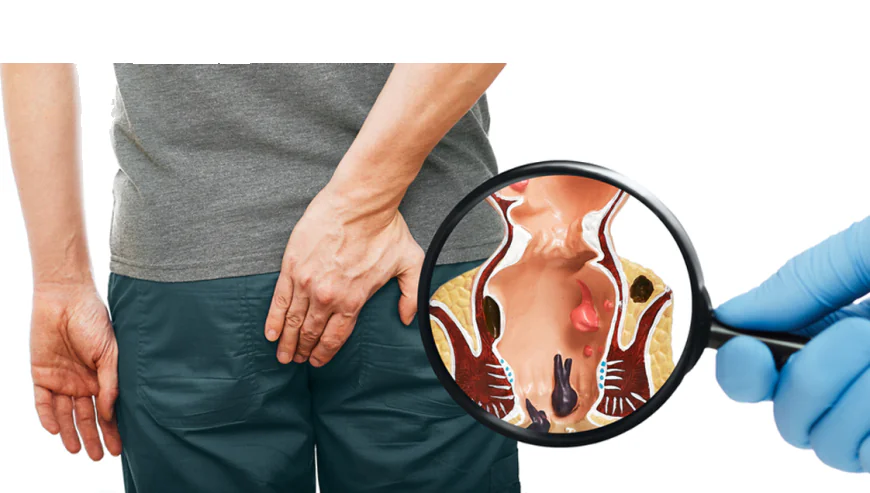 How to Choose the Best Piles Doctor in Kochi: A Complete Guide