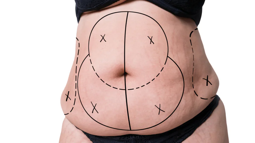 Tummy Tuck in Dubai for Smooth, Refined, and Elegant Stomach