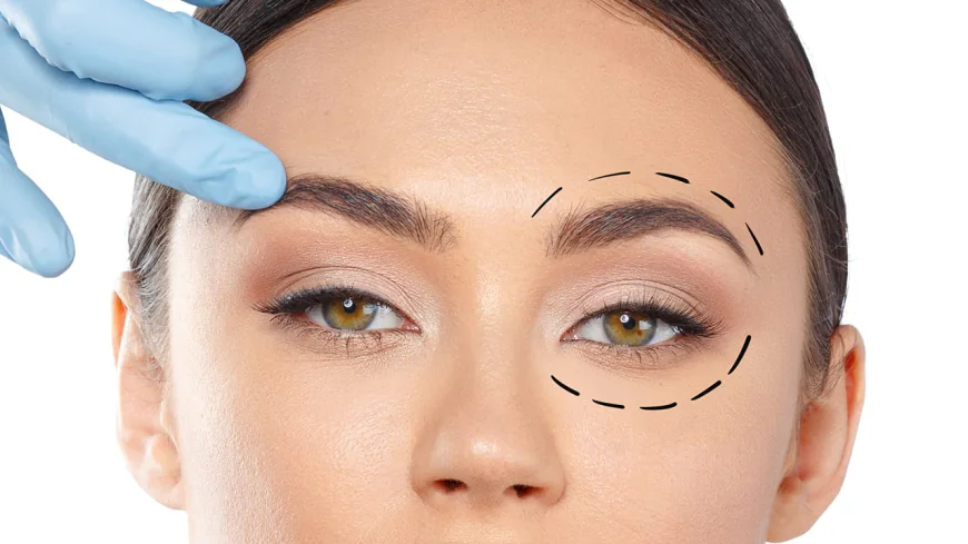 Eyelid Surgery in Islamabad for Droopy Eyes: Causes and Solutions
