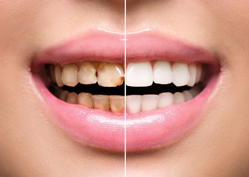 Teeth Scaling and Polishing in Islamabad: Complete Oral Care Guide