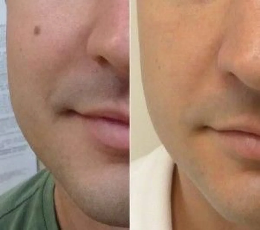 Mole Removal in Dubai: Advanced Laser Techniques