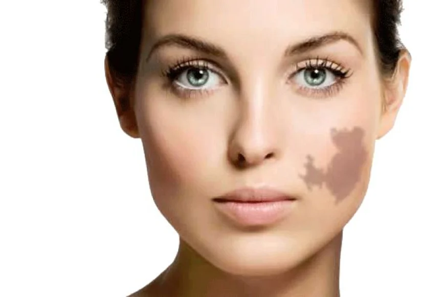 Birthmark Removal in Dubai: Experience Clear, Smooth Skin