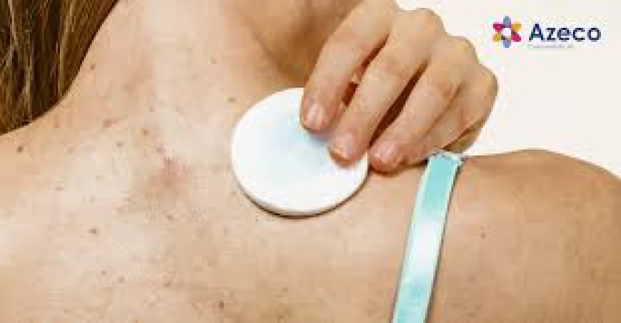 How Do Doctors Diagnose and Treat Shingles Effectively?