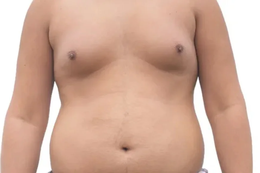 What Is Gynecomastia? Causes, Symptoms, and Treatment Options