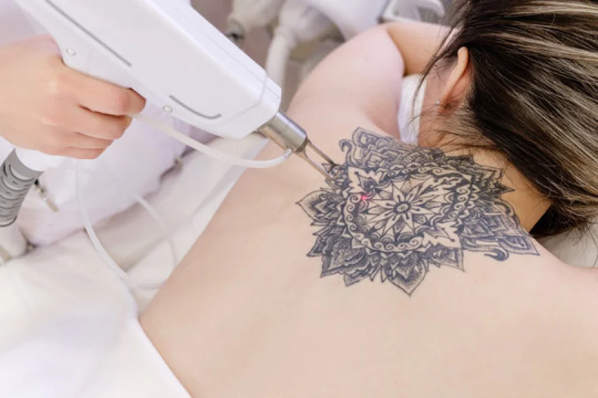 Unwanted Ink? Laser Tattoo Removal Has You Covered