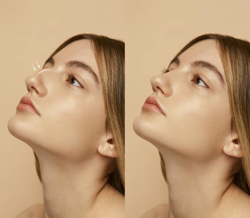 Trusted Rhinoplasty Surgeon in Dubai for Nose Enhancements