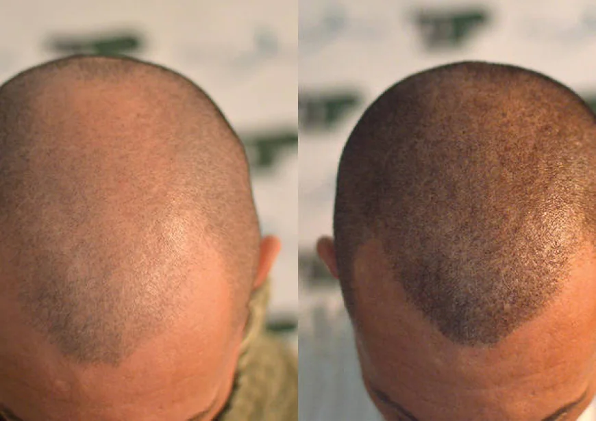 Scalp Micropigmentation in Islamabad for a Fuller, Youthful Look