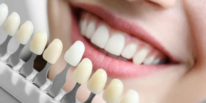The Complete Guide to Cosmetic Teeth Whitening