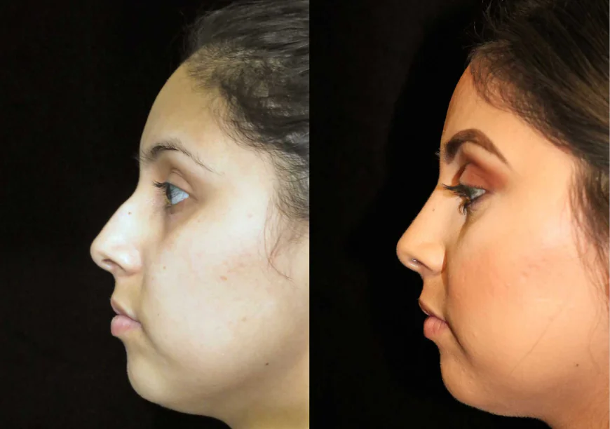 Rhinoplasty for men: Natural and powerful before and after results