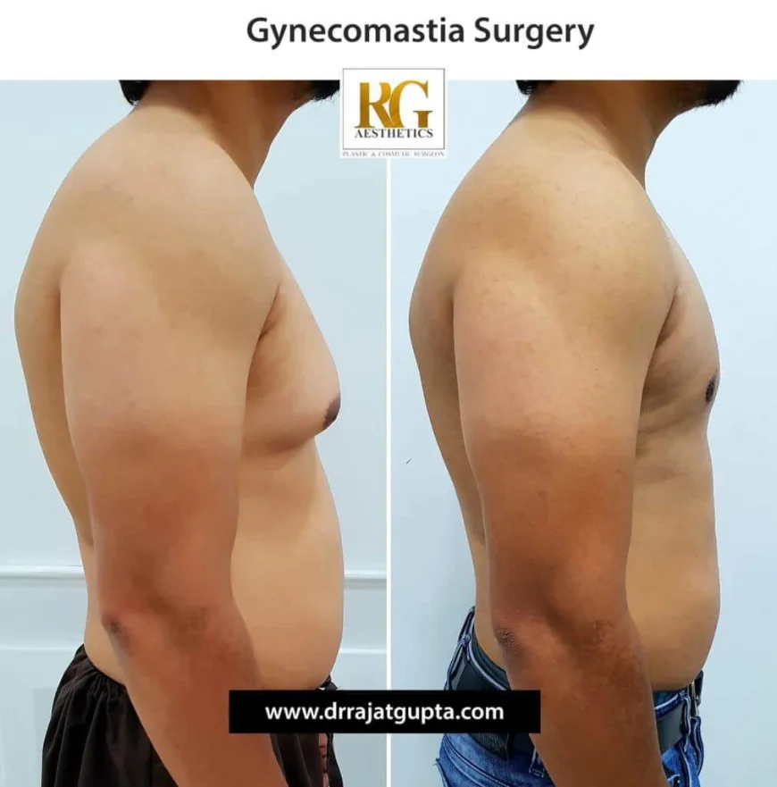 The OCCULT Technique for Gynecomastia