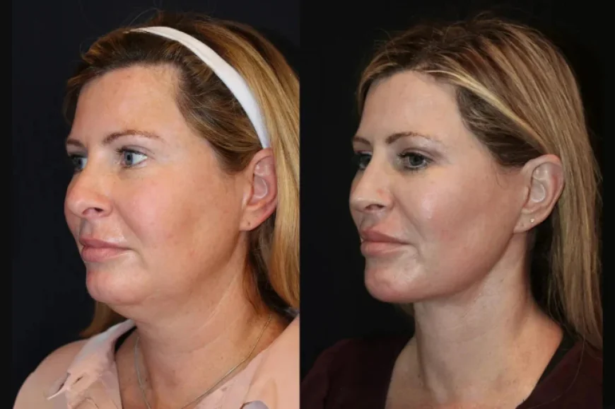 Skin Tightening in Dubai: Expert-Led Procedures for Natural-Looking Outcomes