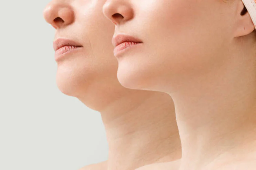 Chin Liposuction in Dubai: Budget-Friendly Contour Upgrade